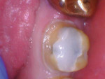 Close-up buccal and lingual photographs of the tooth after it was prepared and a buildup was performed. Note the chamfer margin that was created during preparation.