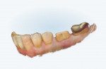 Intraoral scans showing the mandibular arch alone and in occlusion with the maxillary arch.