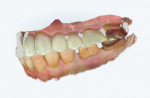 Intraoral scans showing the mandibular arch alone and in occlusion with the maxillary arch.