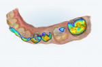 The intraoral scanner’s occlusal clearance tool was applied to generate a color map indicating the interocclusal distances.