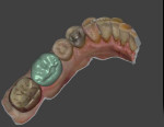 Buccal and occlusal views of the completed digital prosthetic design in the design software during the final review prior to milling. The design can be rotated in any direction, allowing the case to be viewed at every angle needed to ensure that the design will result in a clinically acceptable restoration.