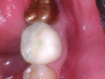 Posttreatment buccal and lingual photographs of the in-office fabricated crown after final cementation.