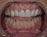 Pretreatment retracted photograph with the teeth apart and close-up maxillary view of the existing maxillary porcelain veneers showing discoloration, marginal staining, and repairs made with composite resin.