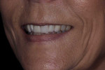 Pretreatment smile, left lateral smile, and right lateral smile photographs as well as a full-face portrait of the patient wearing facial reference glasses (Kois Facial Reference Glasses, Kois Center) for midline assessment. These images convinced the patient to extend treatment into the buccal corridor to include teeth Nos. 4 and 13.