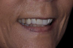 Pretreatment smile, left lateral smile, and right lateral smile photographs as well as a full-face portrait of the patient wearing facial reference glasses (Kois Facial Reference Glasses, Kois Center) for midline assessment. These images convinced the patient to extend treatment into the buccal corridor to include teeth Nos. 4 and 13.