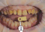 After a series of burs was used to remove the old porcelain veneers, as well as light areas of decay, and prepare teeth Nos. 4 through 13 for treatment, a preparation shade tab photograph was acquired for communication with the laboratory.