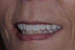 Smile, left lateral smile, and right lateral smile photographs of the provisional restorations, which were fabricated chairside from a self cure composite material (Telio CS C&B [shade A1], Ivoclar) using a putty matrix and then luted to teeth Nos. 4 through 13 (Adhese® Universal, Ivoclar).