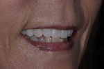 Smile, left lateral smile, and right lateral smile photographs of the provisional restorations, which were fabricated chairside from a self cure composite material (Telio CS C&B [shade A1], Ivoclar) using a putty matrix and then luted to teeth Nos. 4 through 13 (Adhese® Universal, Ivoclar).