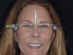 A full-face smile portrait of the provisionalized patient wearing facial reference glasses to confirm midline position was sent to the laboratory along with the rest of the pretreatment photographs and an intraoral scan of the provisional restorations.