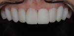 Retracted close-up maxillary polarized photograph of the final veneers placed with two different shades of try-in paste (Variolink Esthetic Neutral [teeth Nos. 4 through 8] and Light Plus [teeth Nos. 9 through 13], Ivoclar) to help the patient best visualize the shade of her final restorations. The patient chose the Neutral shade to better blend with her natural mandibular teeth.