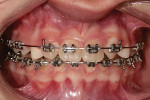 Fig 1. Pretreatment retracted photograph of a 13-year-old female patient who presents with missing maxillary lateral incisors, retained primary maxillary canine teeth, and her permanent canine teeth orthodontically moved into the maxillary lateral incisor positions.