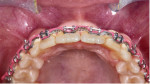 Fig 3. Soft- and hard-tissue deficits are present at the maxillary lateral incisor sites.