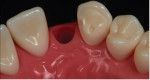 Fig 6. Tooth model demonstrating the technique used to prepare the canine abutment teeth for bonded single-wing zirconia bridges. Note the anti-rotation groove placed on the mesial aspect of the canine abutment.