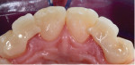 Fig 7. Posttreatment palatal view of the bonded zirconia bridges. Note the anti rotation extensions of the framework that contact the palatal surfaces of the central incisors.