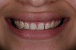Fig 2. Pretreatment close-up view of the patient’s smile. She complained that her smile had a childlike appearance.