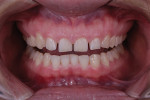 Fig 4. Pretreatment retracted view. Note minimal attrition on anterior teeth.