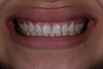 Fig 5. The patient did not like the excessive gingival display when she smiled.