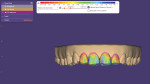 Fig 6. Restoration planning in software, over the final stage of orthodontic planning.