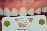 Fig 10. Shade selection using the eLAB card. With this technique, the clinician focuses on the teeth adjacent to the teeth being restored and will ask the lab to assign a numerical color value of the unprepared teeth to match the adjacent teeth shade and not the preparation shade.
