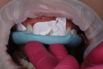 Fig 13. Direct composite restorations bonded onto teeth Nos. 6 and 11 using a lingual matrix.