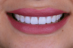 Fig 15. Post-treatment close-up view of patient’s smile.