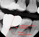 Fig 2. Type 1 restorative solutions have sharp angles that create major stress concentrators, long cantilevers, and a lengthy implant–tooth distance, which can lead to mechanical and biological complications.
