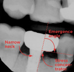 Fig 3. Type 2 restorative solutions have major stress concentrators, narrow necks, obtuse emergence angles, and lengthy implant–tooth distances, which can lead to mechanical and biological complications.