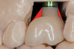 Fig 5 and Fig 6. By filling in the emergence profile with prosthetic material (represented in red), a type 1 prosthesis (Fig 5) can be easily changed into a more desirable type 3 prothesis (Fig 6).