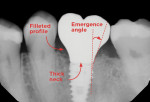 Fig 7. Type 3 restorative solutions have acute emergence angles, thick necks, minimized cantilevers, and smooth, filleted emergence profiles, all of which can minimize mechanical and biological complications. (Radiograph has been inverted for illustrative purposes.)