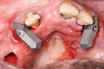 Fig 3. Initial extractions and scan gauges in place on multi-unit abutments secured to underlying implants.