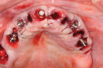 Fig 15. Completion of maxillary flapless immediate implant surgery and placement of multi-unit abutments.