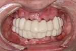 Fig 38. Maxillary and mandibular provisional restorations inserted, day of surgery