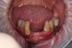 Fig 43. Case 4: At presentation the patient had a failing mandibular dentition.