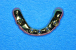 Fig 50. A gold anodized titanium milled bar supported the overlaying zirconia. The bar was milled directly to the multi-unit abutment interface.