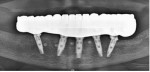 Fig 52. Final radiograph confirmed complete seating of the final restoration.