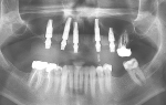 Fig 6. Postoperative panoramic radiograph on the day of surgery.