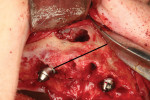 (2.) View of the sinus window preparation following implant placement. The mesial extension of the sinus window allows access to the most anterior wall of the sinus. This slope pointing toward the pyriform aperture will guide the implant direction and insertion into the dense cortical bone available.