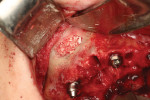 (4.) An allograft bone material was placed into the sinus window and densely packed to rebuild the alveolar deficiency.