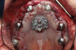 (6.) Occlusal view of the maxillary implant distribution. Six implants were placed, including two axial implants, two trans-sinus implants, and two pterygoid implants. All of the implants achieved a primary stability of greater than 50 Ncm.