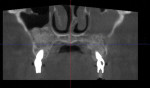 (9.) Coronal view of the postoperative CBCT scan highlighting the volume of bone graft placed apical and distal to the trans-sinus implants.