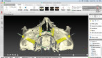 (1.) CAD software view of a case demonstrating the planned positions of two transnasal implants accompanied by two zygomatic implants.