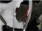 (4.) View of a 3D printed prototype of a patient’s facial bones being used to evaluate the height of the alveolar ridge, the shape of the nasal cavity, and the availability of implant anchorage in the frontal process of the maxilla to determine if the transnasal technique is indicated.