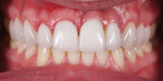 (2.) An upper anterior esthetic rehabilitation to correct the incisal edge discrepancies was completed at age 36, which also used pink porcelain to correct the undesirable soft-tissue esthetics associated with the severe ridge defect and growth changes.