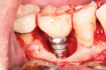 (1.) Close-up view of an implant-supported restoration in the mandibular right first molar position after a flap was reflected to expose a significant intrabony defect resulting from peri-implantitis.
