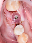 (4.) Postoperative view of a custom healing abutment placed by the surgeon at the time of implant placement to develop the soft-tissue contours.