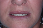Fig 1. The patient with the current full maxillary and mandibular dentures in a relaxed lip position.