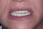 Fig 2. The patient smiling with the current dentures demonstrating edge-to-edge anterior occlusion and lack of contact on the anterior teeth on the left.