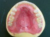 Figure 10  Conventional dentures.