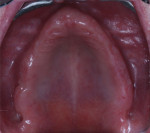 Fig 4. Occlusal views of the edentulous maxillary and mandibular arches.