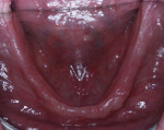Fig 5. Occlusal views of the edentulous maxillary and mandibular arches.